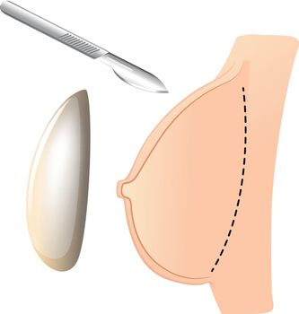 Breast augmentation with implant and knife
