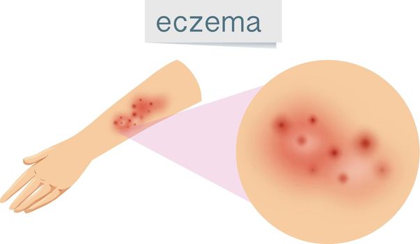 A Vector of Eczema on Skin