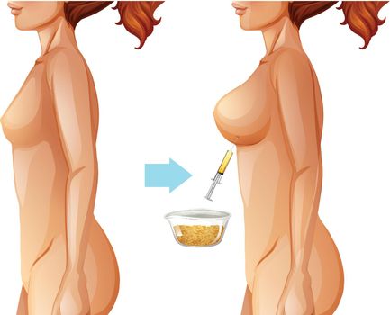 Breast augmentation fat transfer method