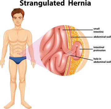 Human Anatomy of Strangulated Hernia