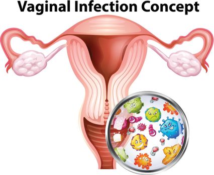 Vaginal infection bacteria concept