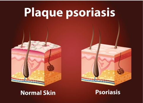 Diagram showing plaque psoriasis