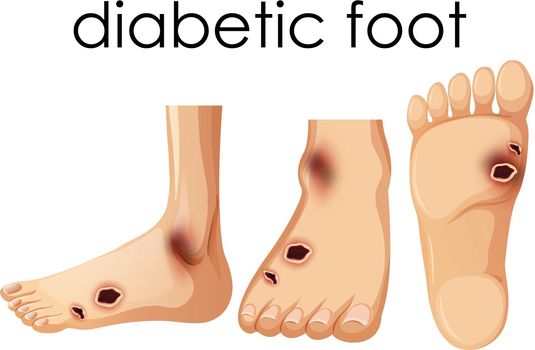 Human Foot with Diabetic