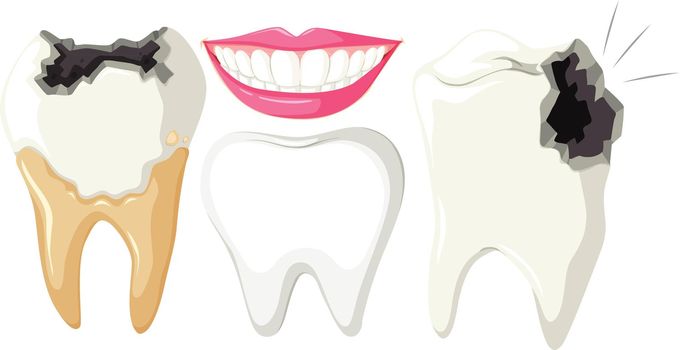 Tooth Decay on White Background