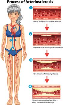 Process of arteriosclerosis medical illustration