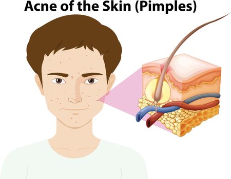 A Young Man with Pimple on Face