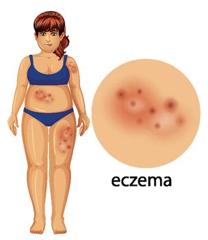 Diagram showing woman with eczema