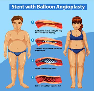 Diagram showing stent with balloon angioplasty