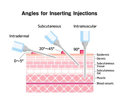Angles for Inserting Injections vector illustration