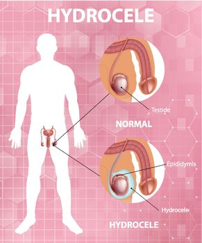 Medical poster showing different between male normal testicle and hydrocele illustration