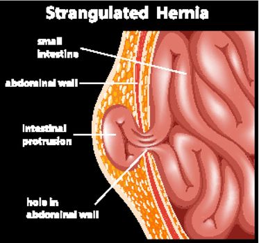 Strangulated hernia anatomy diagram