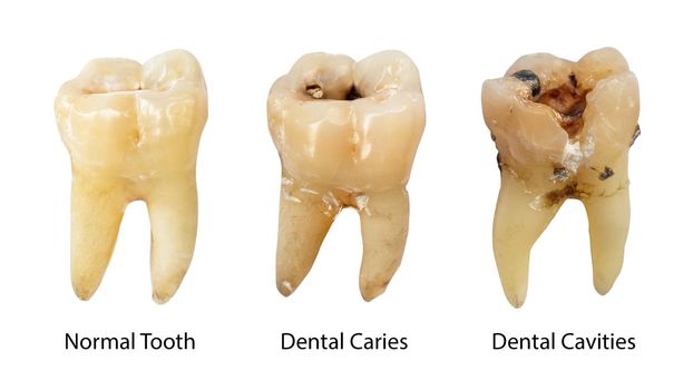 Normal tooth , Dental caries and Dental cavity with calculus . Comparison between difference of teeth decay stages . White isolated background . Front side view .