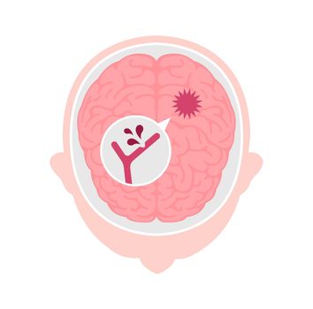 Types of human brain stroke vector illustration | Cerebral hemorrhage