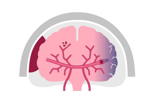 Types of human brain stroke vector illustration