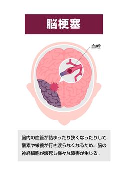 Types of human brain stroke vector illustration | Cerebral infarction