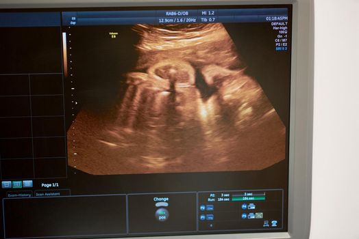 Pregnancy sonogram x-ray on a monitor of ultrasound scanner