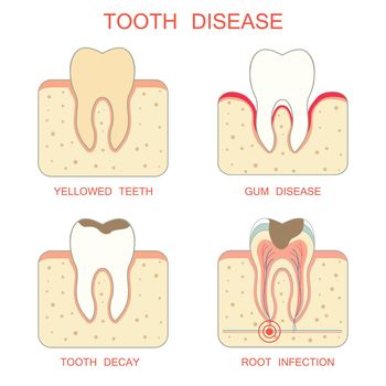 tooth decay disease